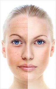 Advanced Corrective Peel